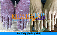 BN vẩy nến Thúy (Quảng Ninh)